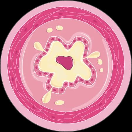 Inflamed bronchial airway — obstructed pre-treatment
