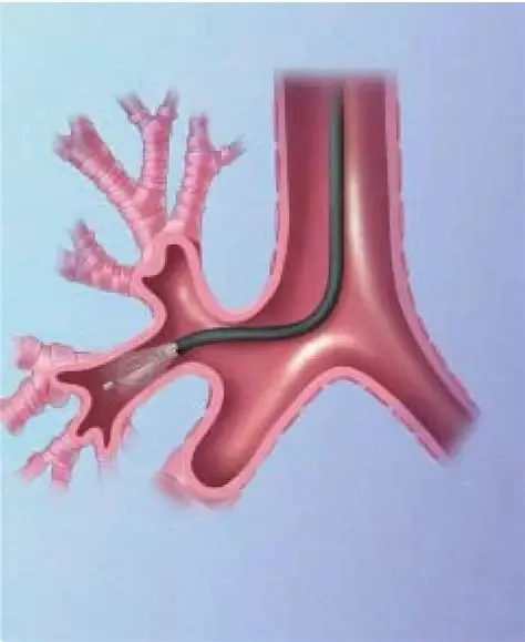 BronchoTech Resector Balloon — the flagship interventional pulmonology device