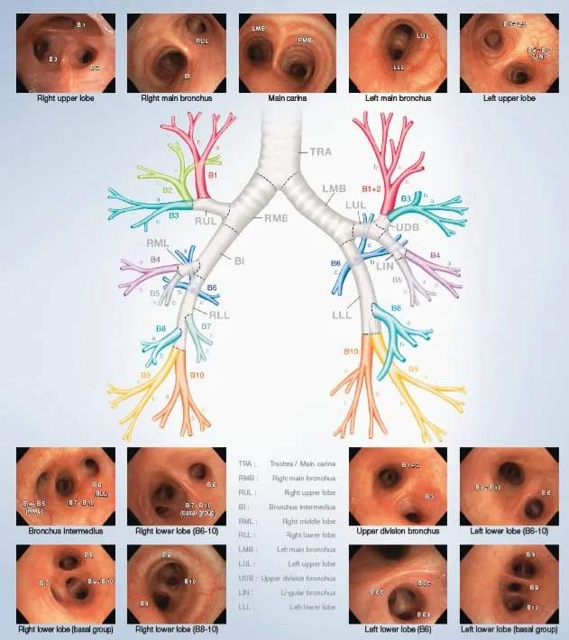 Bronchial airway anatomy — the interventional target of the Resector Balloon